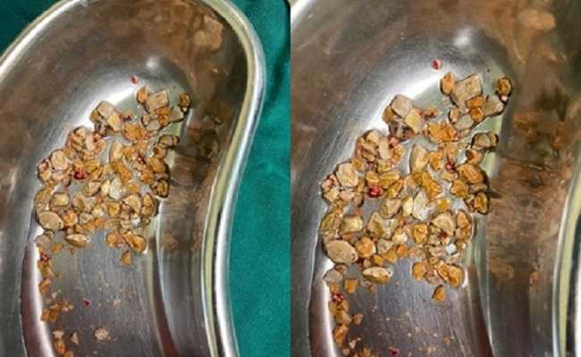 206 kidney stones removed from man in Hyderabad